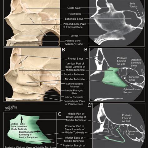 Perpendicular Plate Of Ethmoid Bone Ct Slidesharetrick