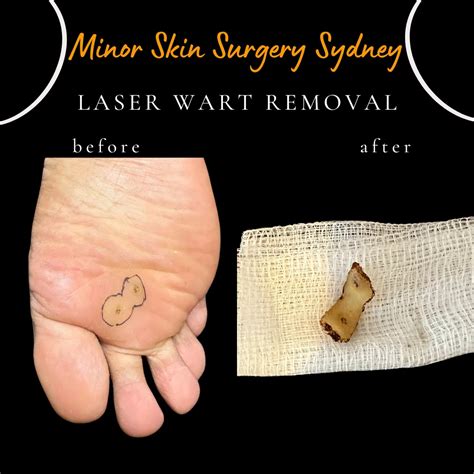 Laser Wart Removal & Treatment Sydney - Finger warts, Plantar warts ...