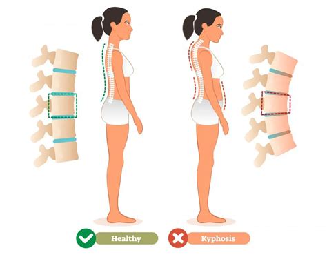 Kyphosis (Roundback) of the Spine – Causes and Treatment | Healthtian