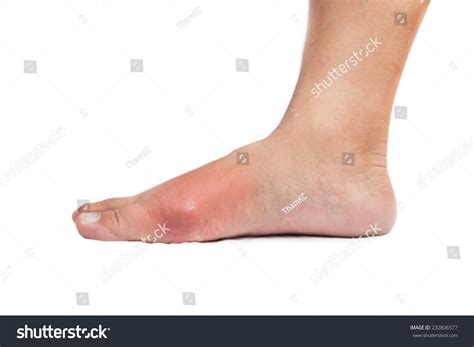 Painful Gout Inflammation On Big Toe Stock Photo 232806577 Shutterstock