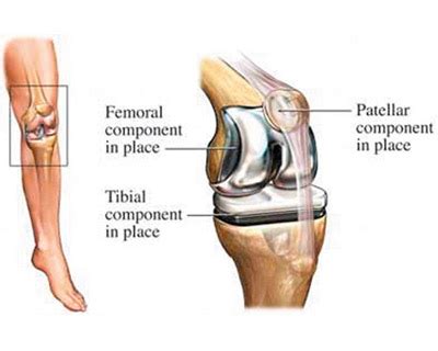 Total Knee Replacement Tkr Superspecialitycare