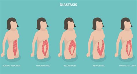 How To Fix Diastasis Recti Years Later A Comprehensive Guide For Long