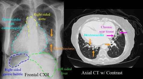 Pin on Kartagener Syndrome