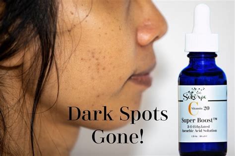 The treatment of dark spots depends on the underlying cause, but here ...