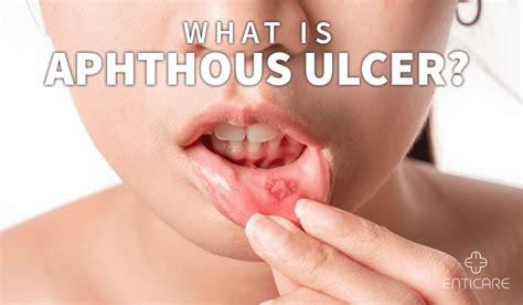 Aphthous Stomatitis What Is It Symptoms And More Osmosis Off