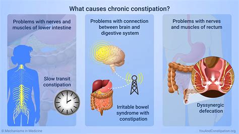 Slide Show - Understanding Chronic Constipation