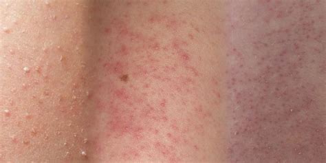 Treatment of Keratosis Pilaris – Chicken Skin | Victoria Health