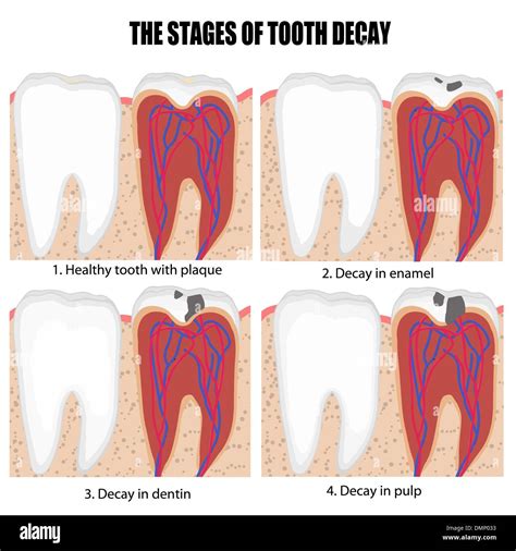 Tooth Decay Diagram