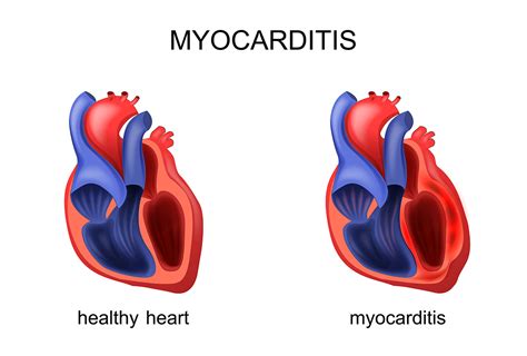 What Is Myocarditis Myocardium Symptoms And Causes Dr Raghu