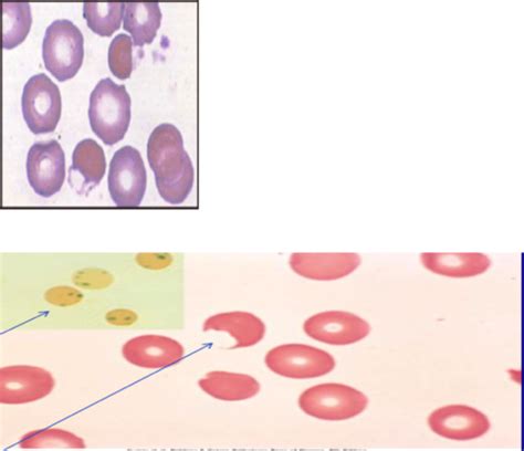 Anemia Microcytic Normocytic And Microcytic Flashcards Quizlet