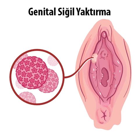 Siğil Yaktırma Nedir Genital Siğil Yaktırma Nasıl Yapılır Op Dr