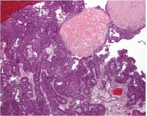 Endometrial Carcinoma Oncohema Key