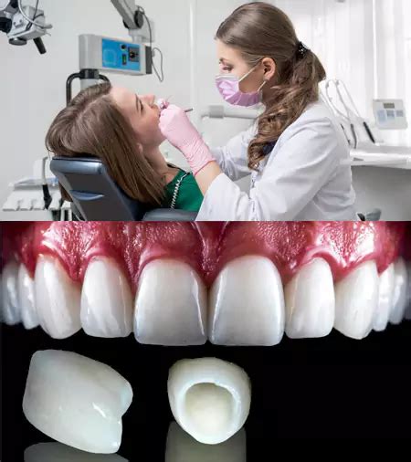 Single Tooth Dental Implant Cost In India FMS DENTAL HOSPITAL