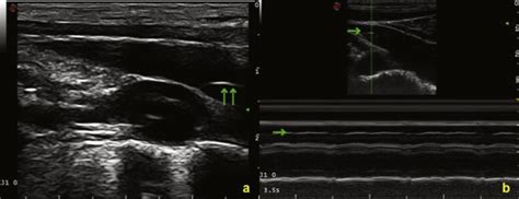 B Mode Evaluation Of The Ijv At J1 Level Longitudinal View A The Download Scientific