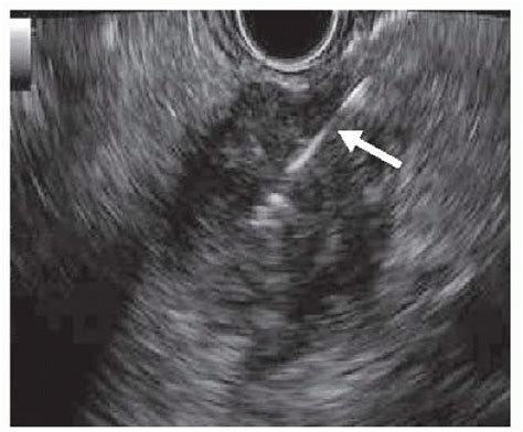 Endoscopic Ultrasonography Of The Pancreas Basicmedical Key