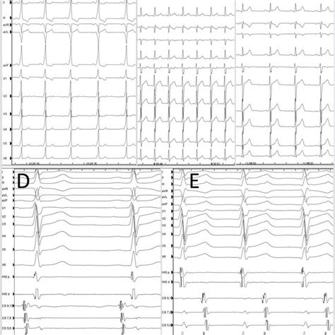 A Twelve Lead Electrocardiogram ECG Showing Sinus Rhythm And