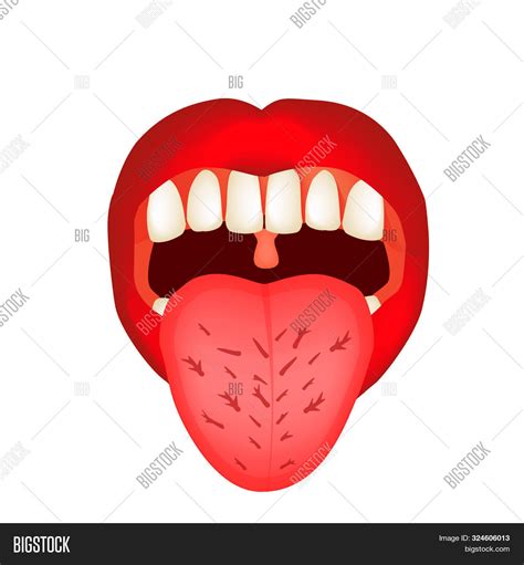 Cracks Tongue. Image & Photo (Free Trial) | Bigstock