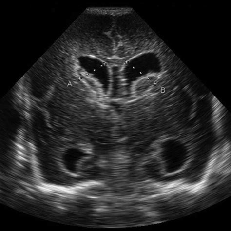 Germinal Matrix Hemorrhage Causes Symptoms Diagnosis Treatment