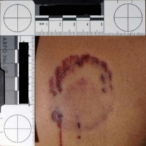 The Bite Mark That Convicted Ted Bundy R Serialkillers