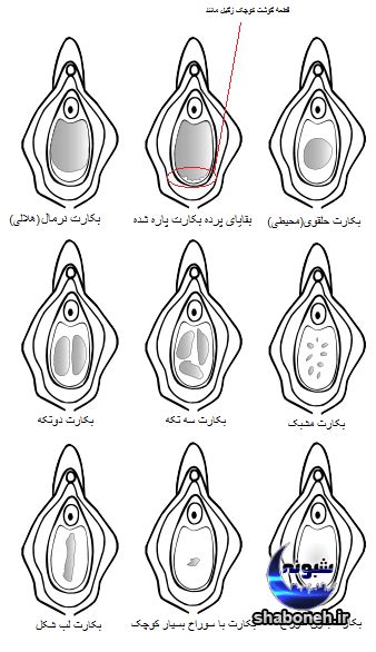 نشانه های پاره شدن پرده بکارت در دختران تصاویر مجله شبونه