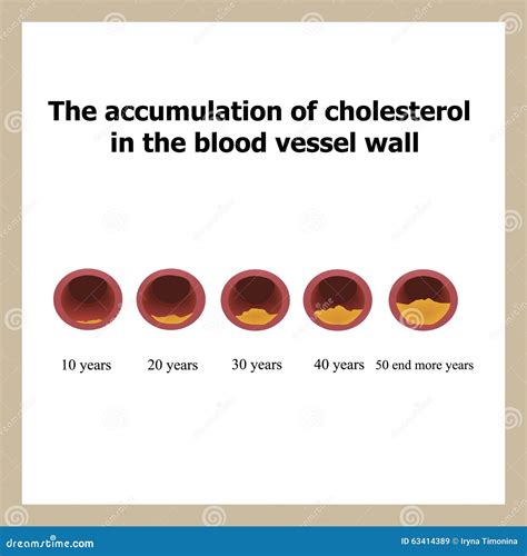 Deposition of Cholesterol in Function of Age. Stock Vector ...