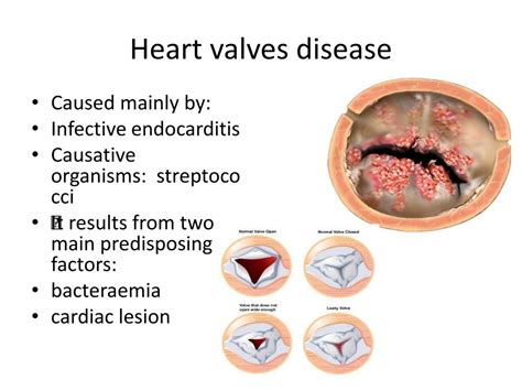 Ppt Overview Of Most Common Cardiovascular Diseases Powerpoint