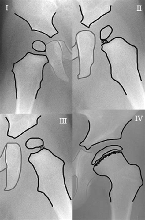 The Kalamchi and MacEwen classification: group I delayed appearance or ...