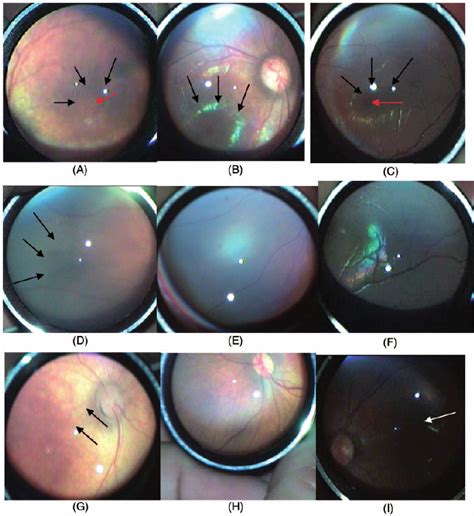 Representative Morphological Features Of Retinal Development In