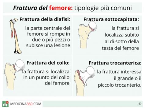 Frattura Del Femore Tipi Sintomi Cause Intervento Riabilitazione E