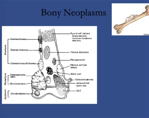 Musculoskeletal Bone Tumors Flashcards Quizlet