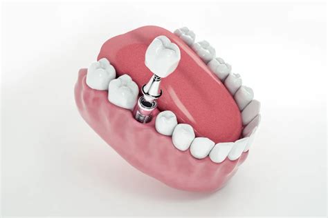 Dental Implants Recovery - Best Practices and Timeline for Healing