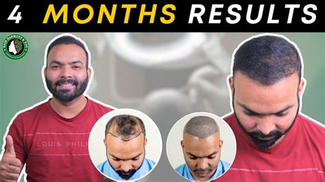 4 Months Hair Transplant Results Best Hair Transplant Result Cost