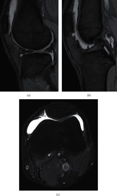 persistent hemarthrosis   knee  arthroscopic meniscal repair