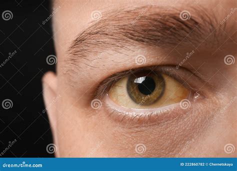 Man Eyes Obstructive Jaundice Yellow Discoloration Real People Liver Dysfunction Icteruswith