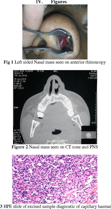 Figure From Capillary Haemangioma Or Pyogenic Granuloma Of Nasal