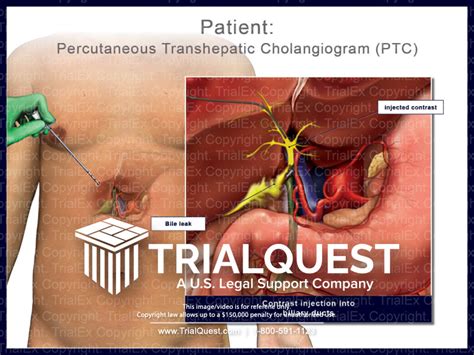 Percutaneous Transhepatic Cholangiography