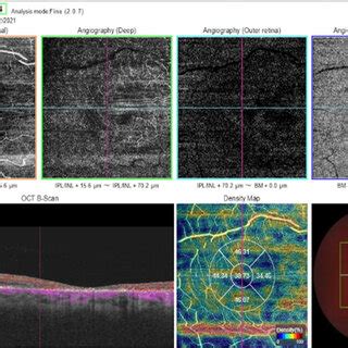 Oct And Octa Imaging At The St Year After Trauma To The Right Eye