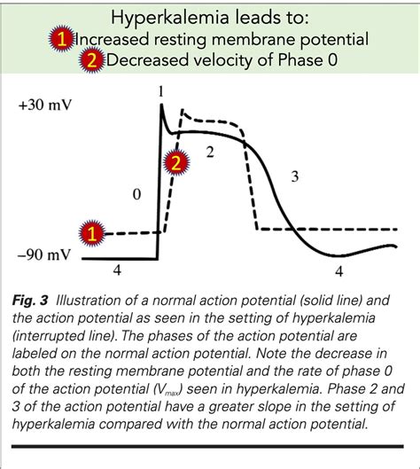 1/17 How does calcium "stabilize the cardiac membrane" in hyperkalemia? I learned early in my ...