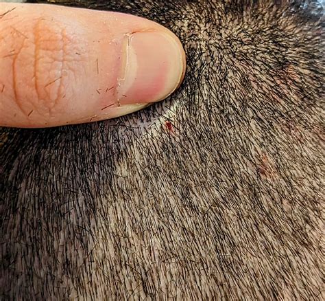 Dermatitis Herpetiformis Scalp Dermatitis Herpetiformis: Causes,