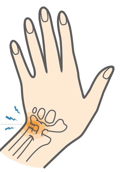 Triangular Fibrocartilage Complex Injury Tfcc Motus Physical Therapy