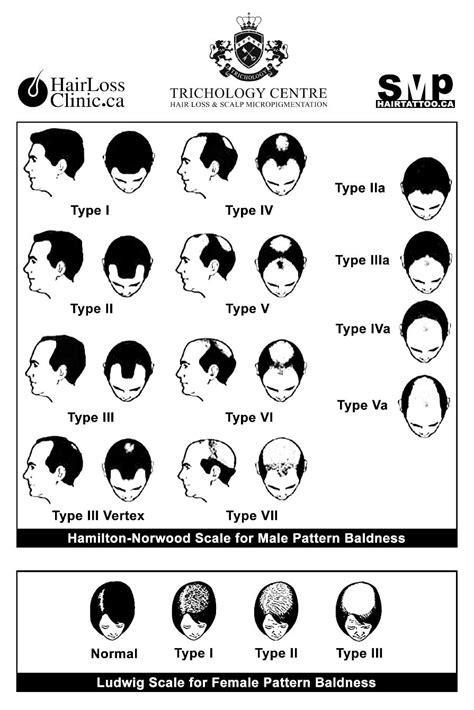 male pattern baldness Norwood Scale Toronto | Hair Loss Clinic | PRP ...