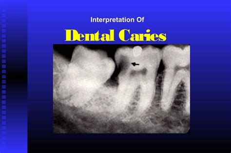 Radiographic Assessment Of Dental Caries Ppt