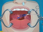 Operate Now Tonsil Surgery Play The Free Game Online