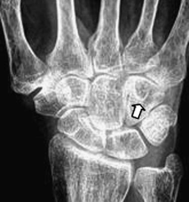 Diagnosing Hook of Hamate Fractures - Sports Medicine Review