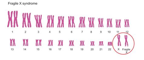 Fragile X Syndrome Fxs Test