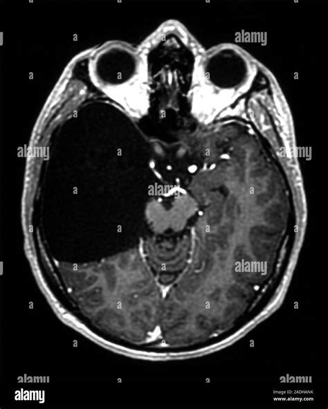 Arachnoid Cyst Magnetic Resonance Imaging Mri Scan Of An Axial Horizontal Section Through