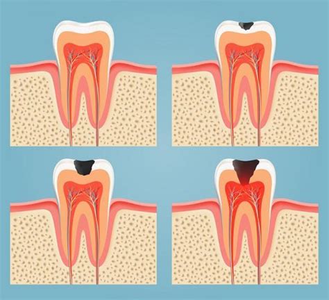 Como aliviar a dor de dente molar remédios caseiros