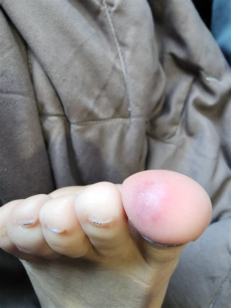 Cellulitis On My Toe Rmedicaladvice