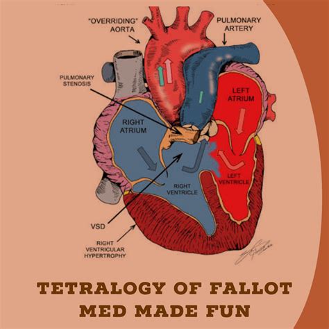 Tetralogy Of Fallot