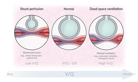 Seduce Visszavonul Között ventilation perfusion ratio Oh Átlátni A nyom